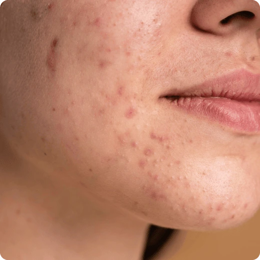acne-pimple-scars