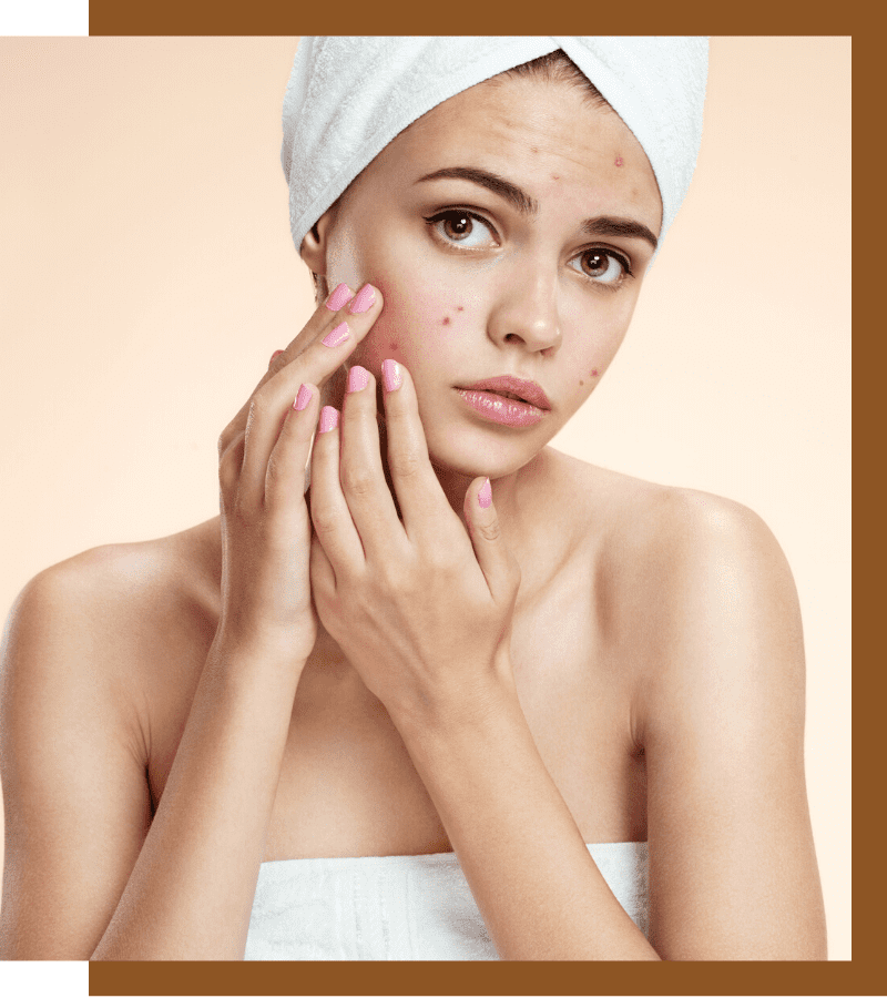 get rid of acne, How to get rid of acne, causes, symptoms, solutions, treatment, Dermiq Clinic