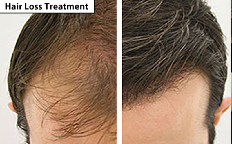, Hair Loss Treatment, Dermiq Clinic