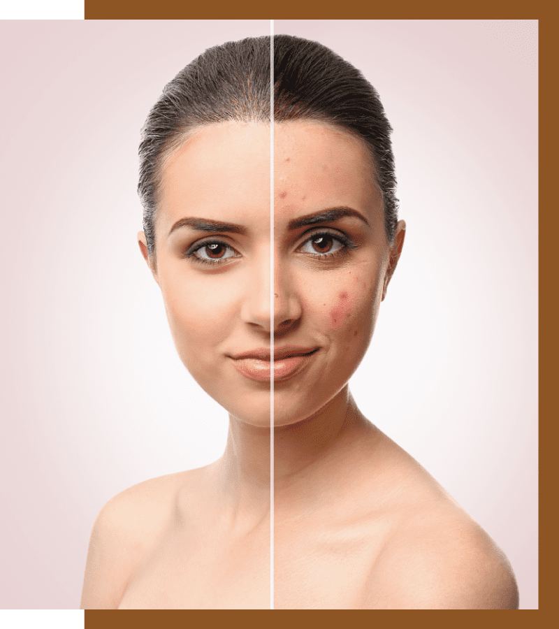 Acne scars Treatment