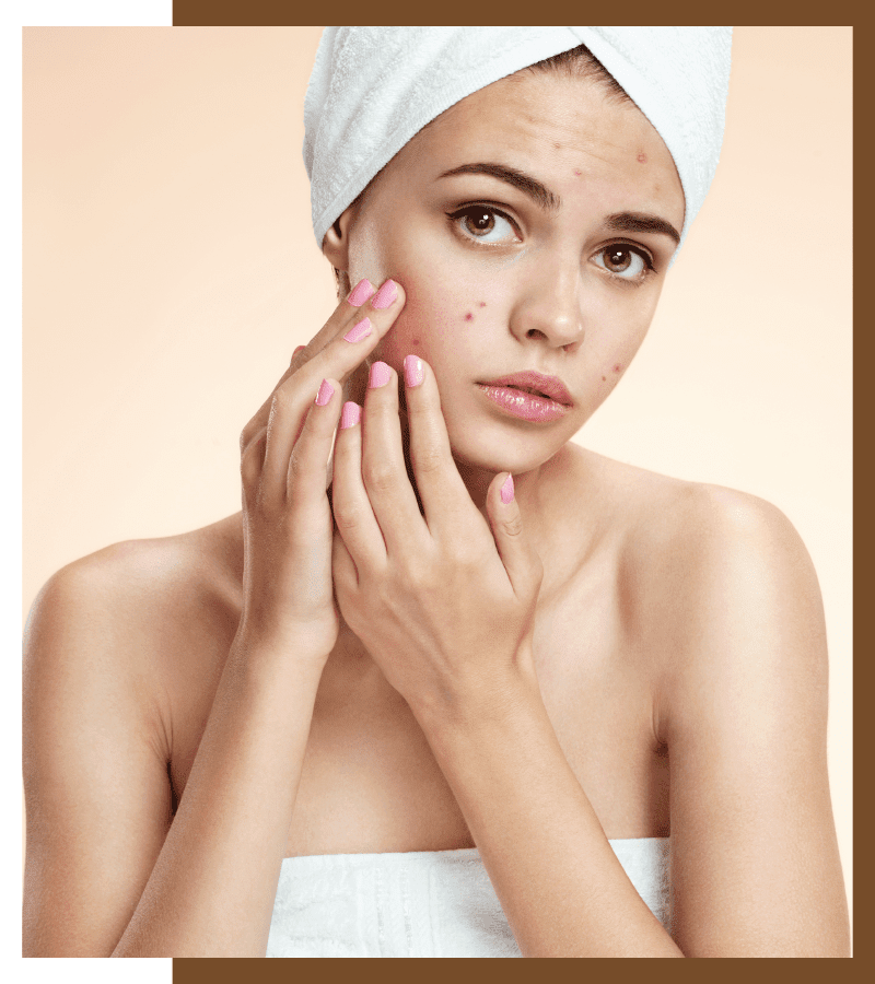 Acne Treatment, How to Treat Acne &#8211; Best Acne Solutions To Look Gorgeous, Dermiq Clinic