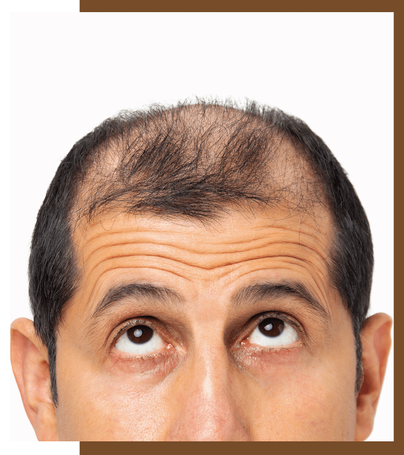 Hair thinning, Everything You Need To Know About Hair Thinning: Causes And Treatments, Dermiq Clinic