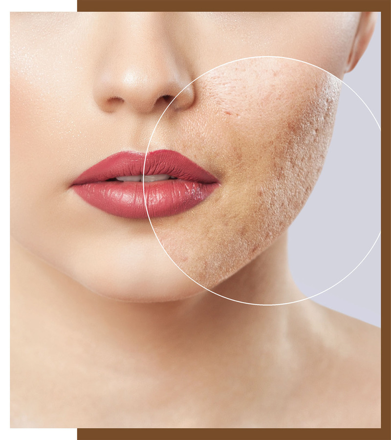 Best Treat Acne Scars, How to Best Treat Acne Scars: A Comprehensive Guide, Dermiq Clinic