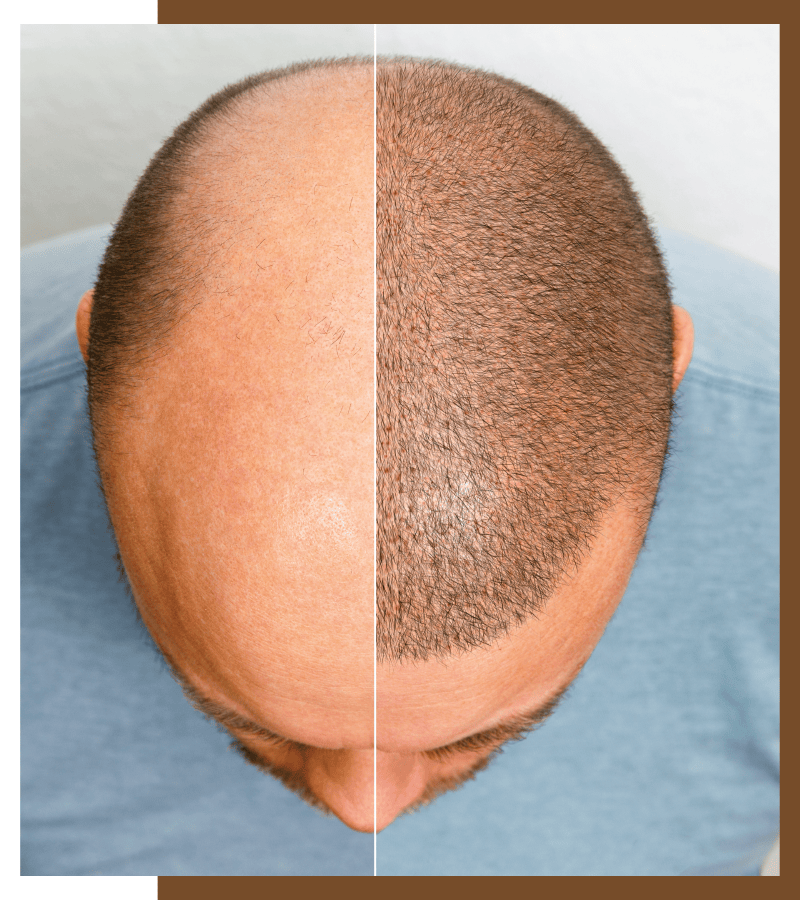 Hair Transplantation, Top 7 Pros And Cons of Hair Transplantation, Dermiq Clinic