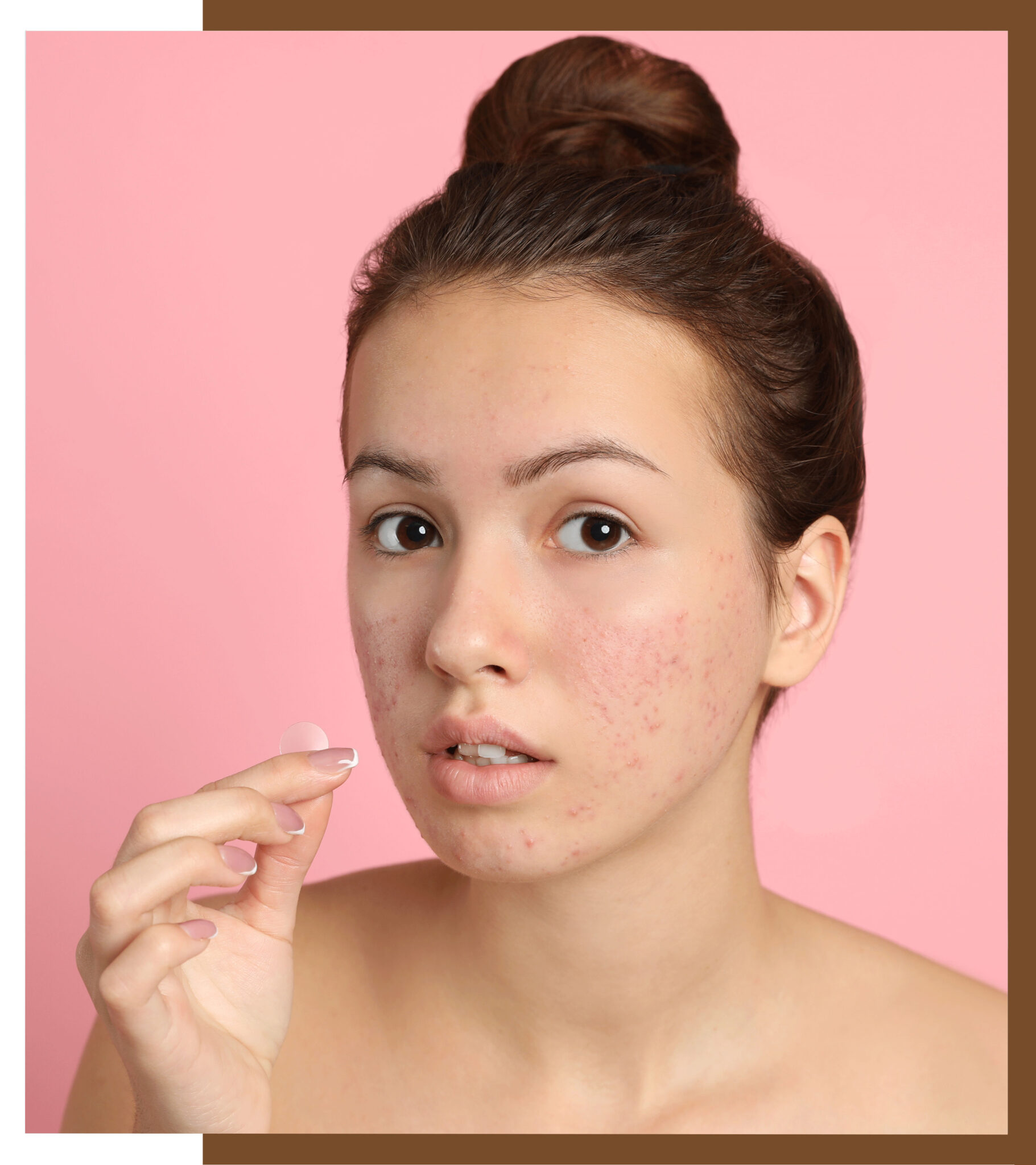 Dermal Fillers, Can Dermal Fillers Help Reverse Acne Scars? A Comprehensive Guide, Dermiq Clinic