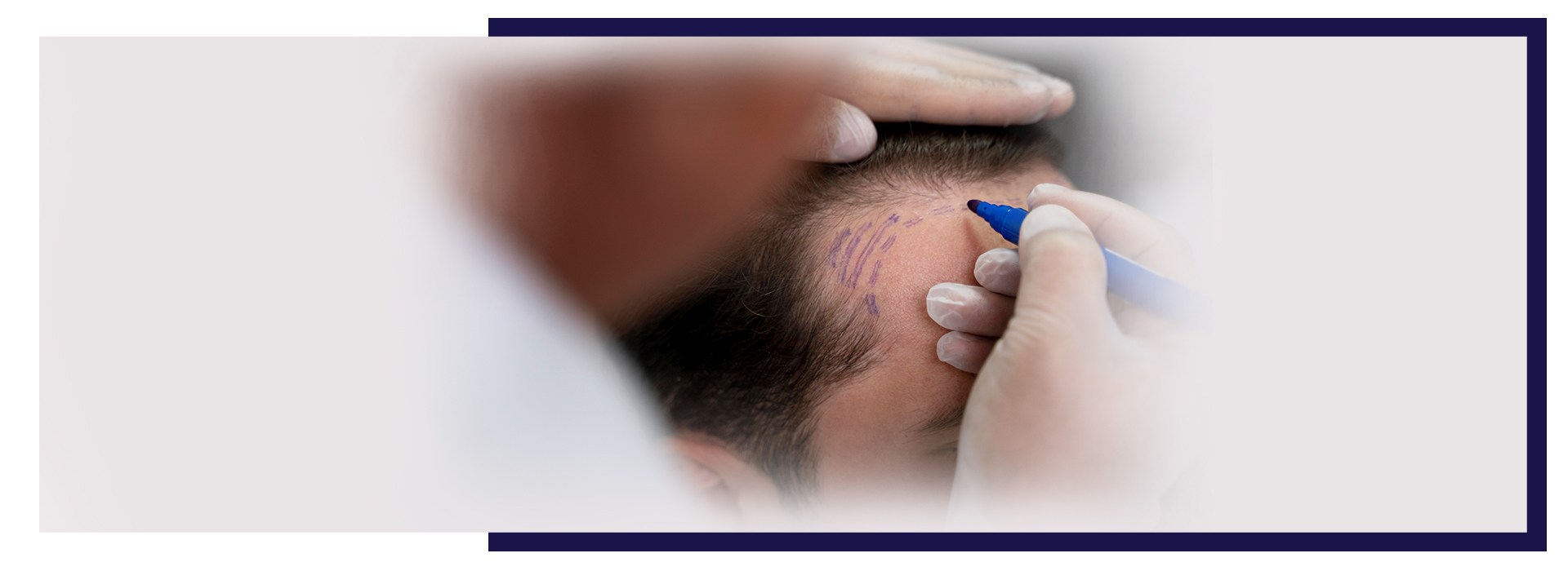 Laser Hair Removal FAQs, 8 Tips for a Smooth Hair Transplant Experience in Hyderabad, Dermiq Clinic