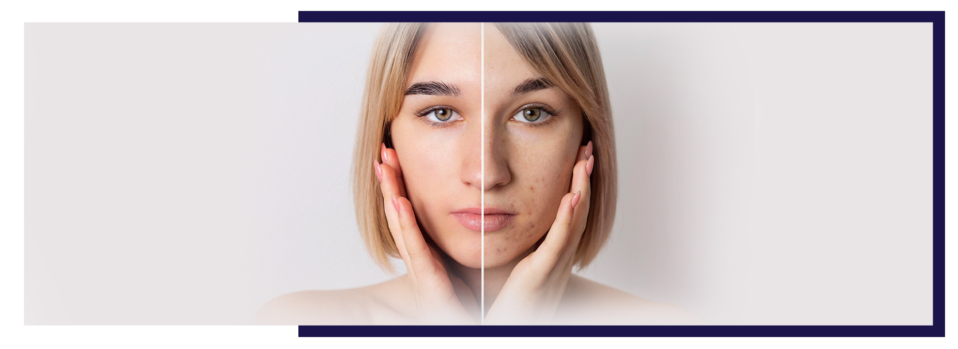 Laser Hair Removal FAQs, Acne Scars Treatments & What Really Works: A Comprehensive Guide, Dermiq Clinic