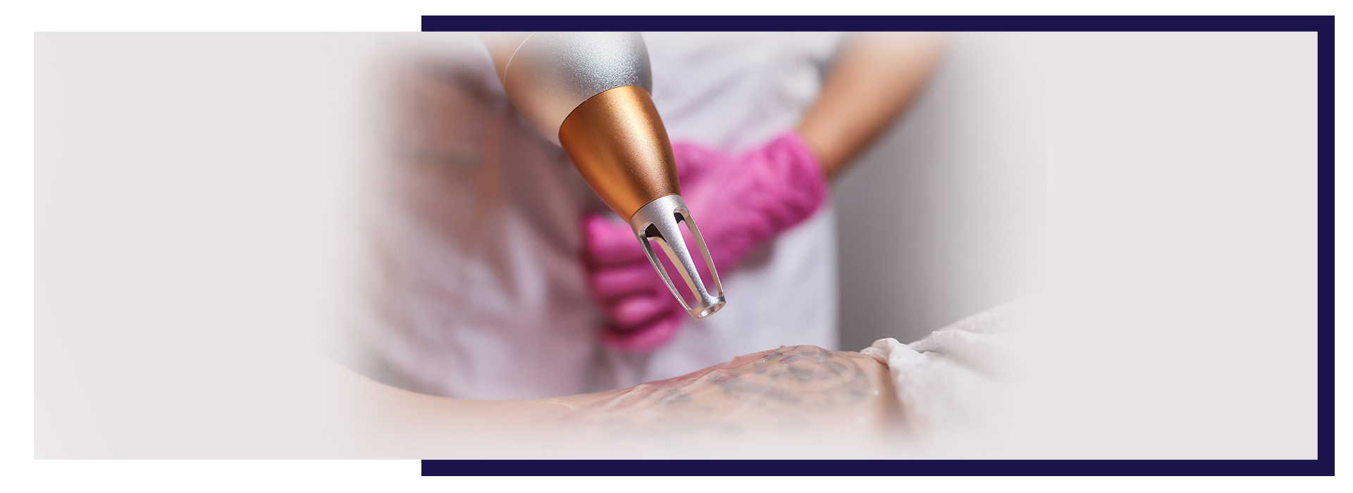 Laser Hair Removal FAQs, Laser Tattoo Removal in Hyderabad | Safe &#038; Effective Treatment, Dermiq Clinic