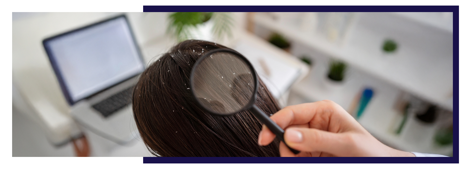 The Best Hair Care Routine For Dandruff Management, The Best Hair Care Routine For Dandruff Management, Dermiq Clinic