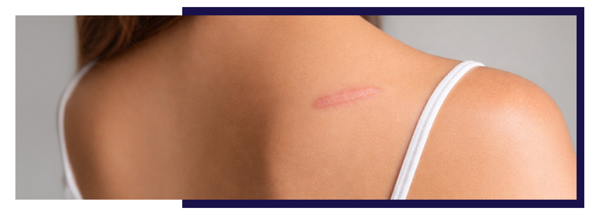 , What Is a Keloid Scar? Causes, Symptoms, and Treatment Options, Dermiq Clinic