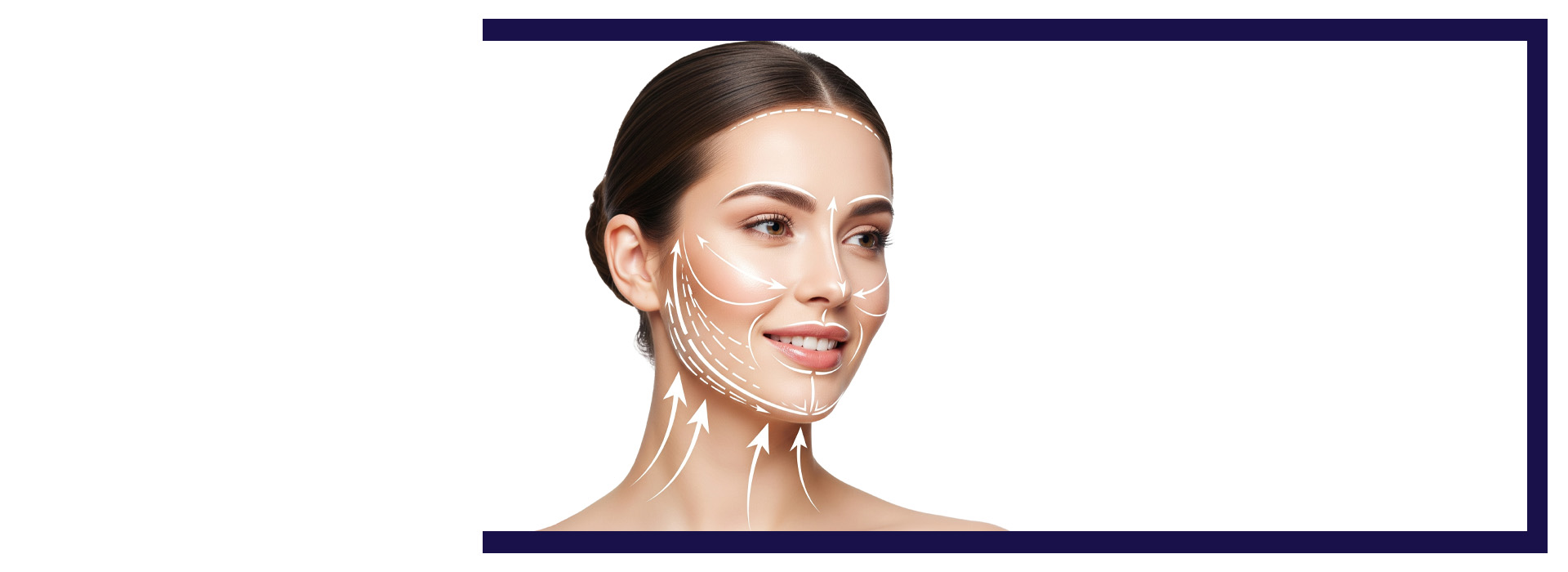, Thread Lift Treatment: A Non-Surgical Way to Lift and Tighten Skin, Dermiq Clinic