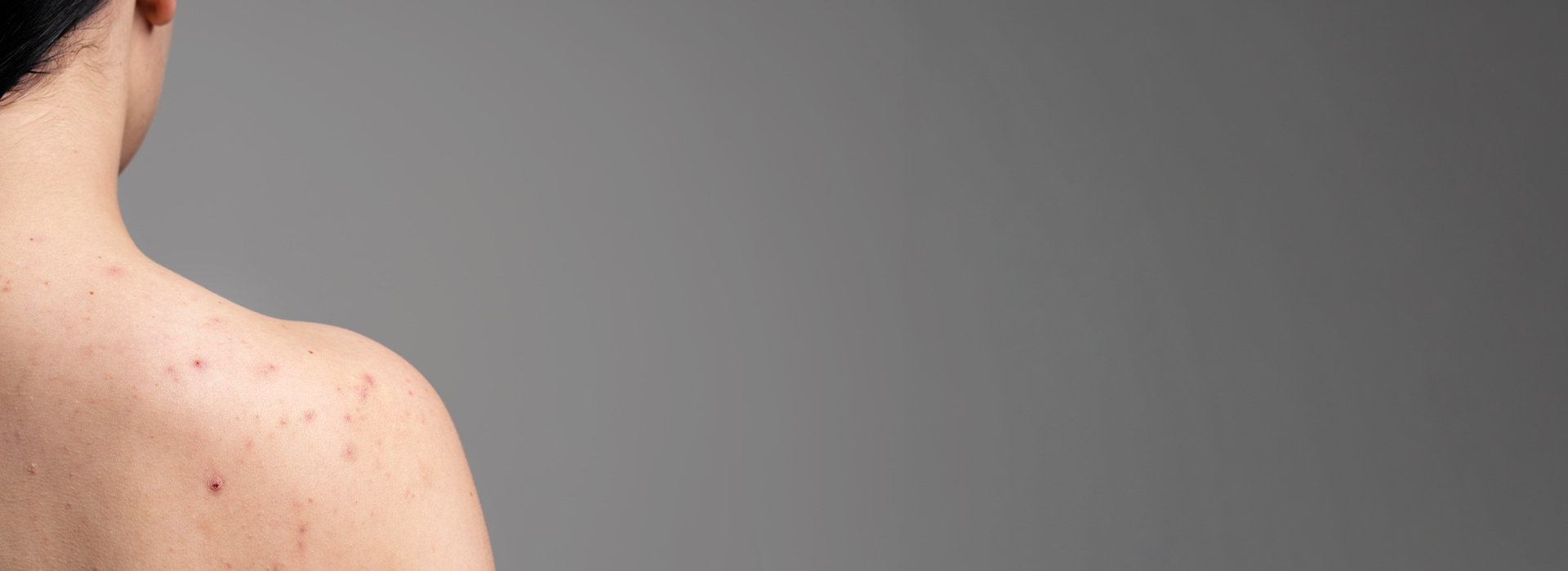 , Back Acne Treatment: Causes, Symptoms, and Effective Solutions, Dermiq Clinic