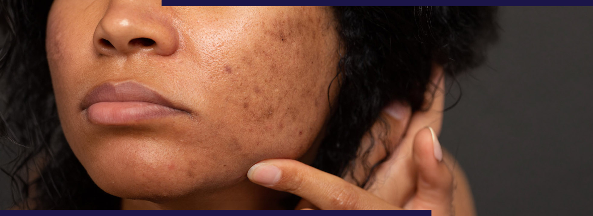 How to remove facial pigmentation, How to Remove Facial Pigmentation Permanently: A Complete Dermatologist Guide, Dermiq Clinic