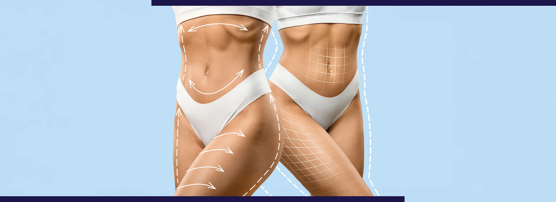 , What to Expect Before and After Body Contouring Treatment, Dermiq Clinic