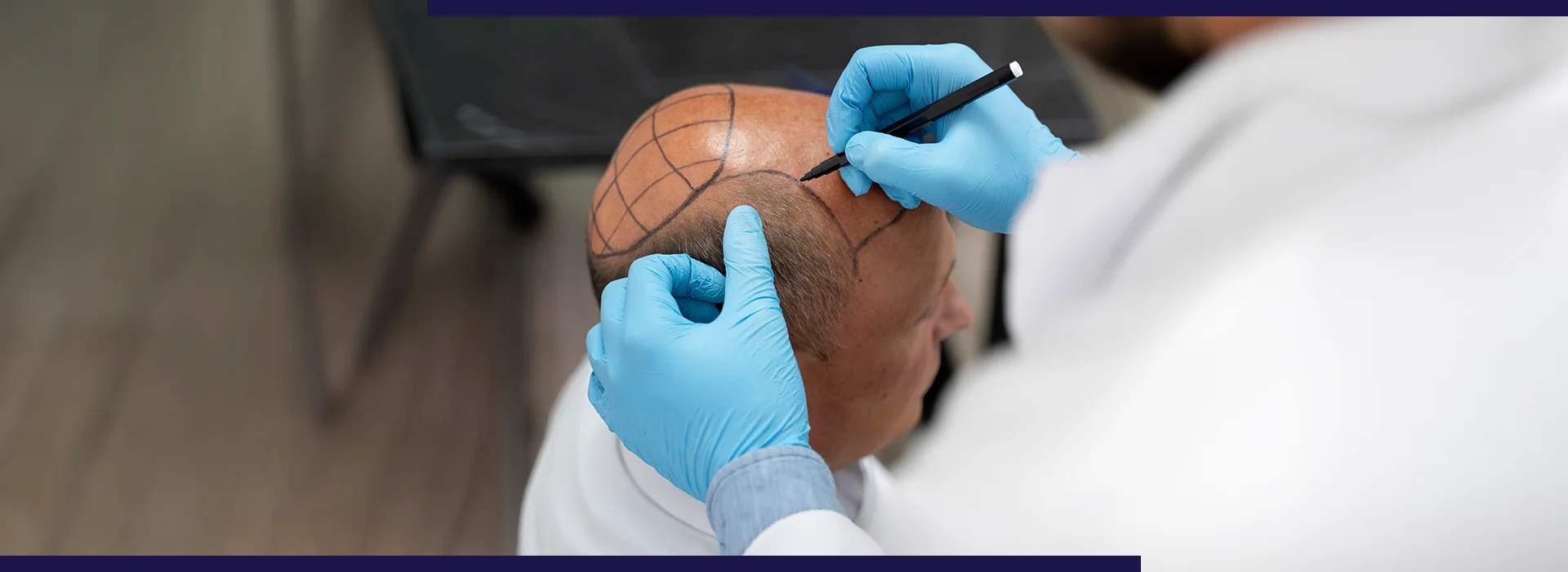 , Hair Transplant Growth Timeline: Month-by-Month Results Explained, Dermiq Clinic