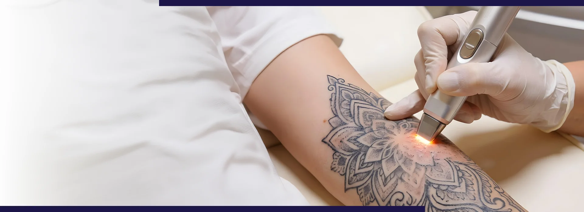 , Things To Know Before Starting Laser Tattoo Removal Treatment, Dermiq Clinic