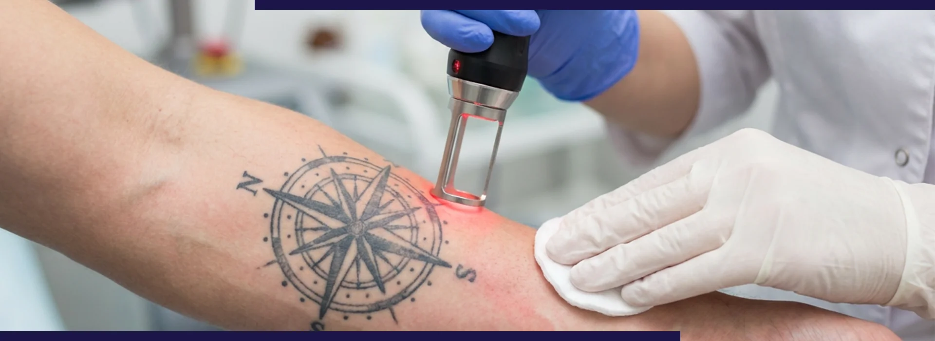 , Safe And Effective Ways To Remove Unwanted Tattoos Permanently, Dermiq Clinic