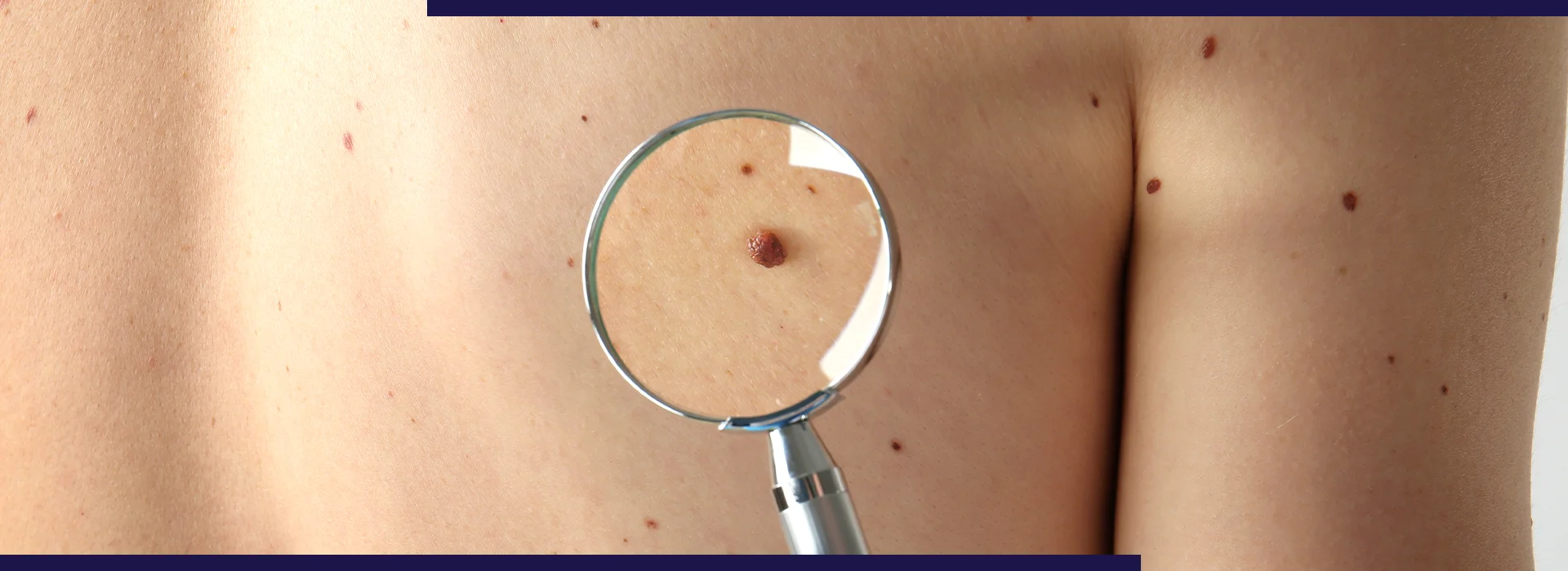 , Common Causes Of Skin Tags And The Best Treatment Options Available, Dermiq Clinic