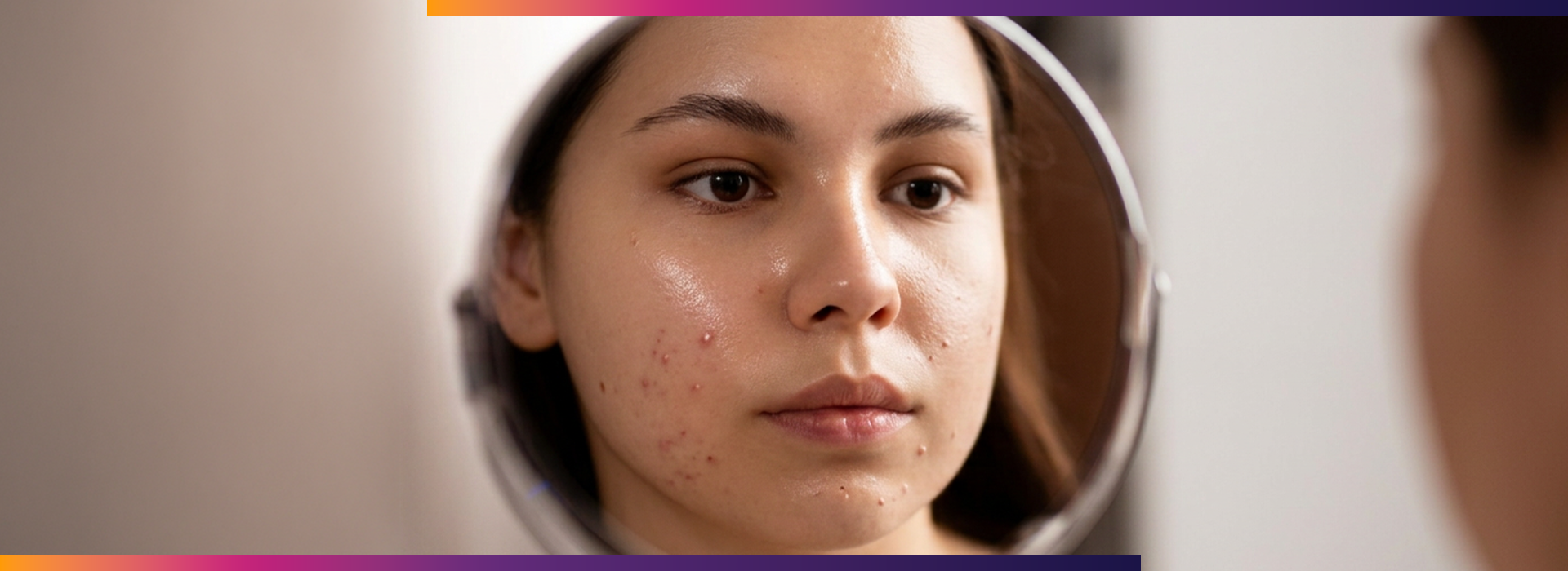 , Best Acne Treatment for Oily Skin | Causes & Options, Dermiq Clinic