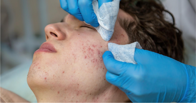Fungal Acne Treatment in Hyderabad - Dermiq Clinic